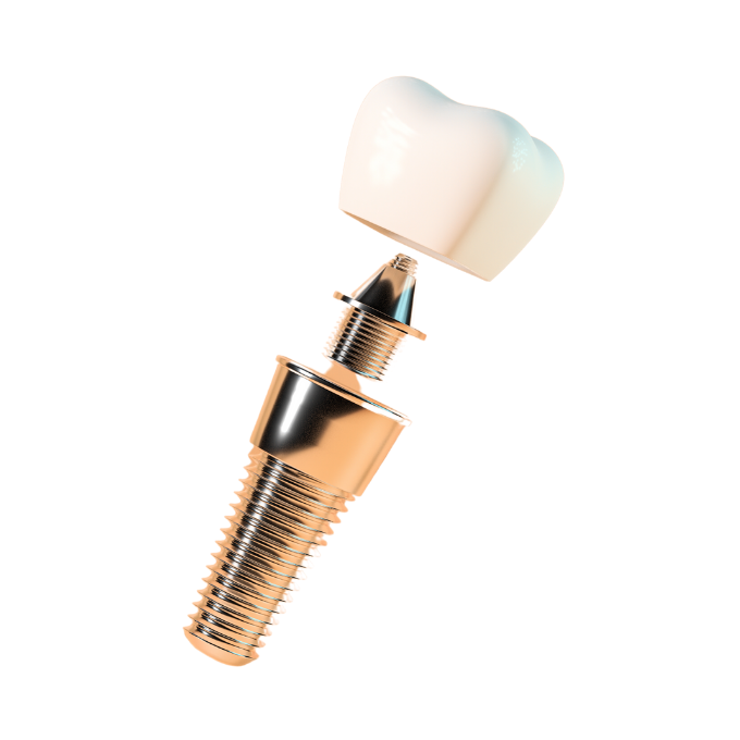 Best dental implants cost UK