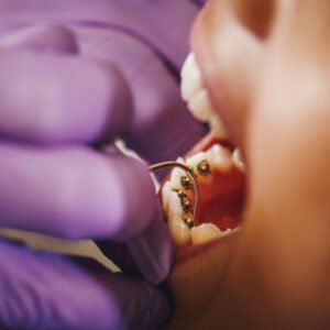 Image of invisible lingual braces being affixed by a dentist at the back of a patient's teeth