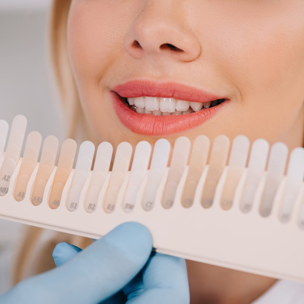 Image of a lady's teeth being compared to a color palette by a dental practitioner to figure out what color must be achieved after whitening