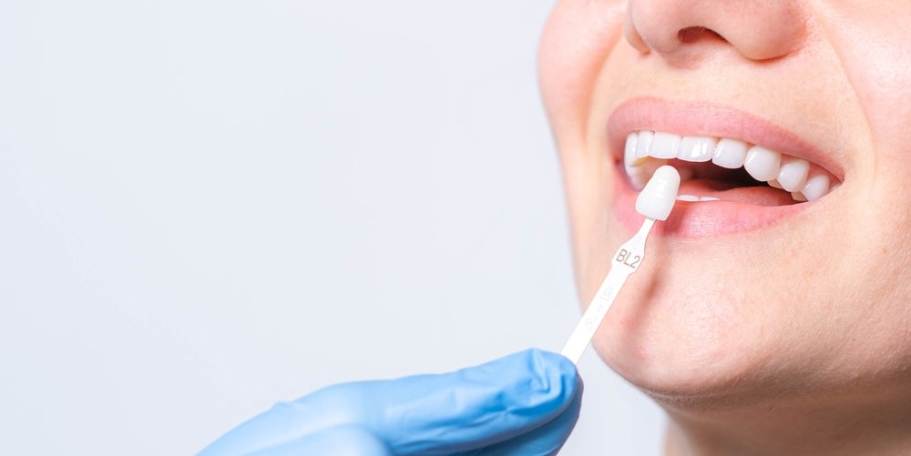 A dentist in a blue glove holds a shade guide tab against a patient’s teeth to match their colour for veneers.