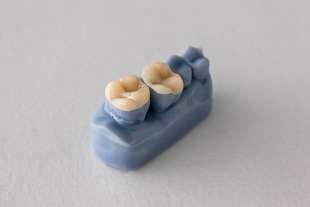 A small blue dental model featuring two crown or inlay restorations on molars.