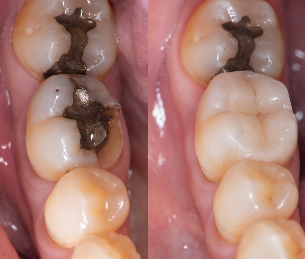 Before and after comparison of two molars, showing silver amalgam fillings replaced with tooth-coloured composite restorations.