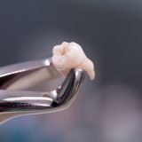 Image of a model tooth held by an extraction tool, as an example of an extraction